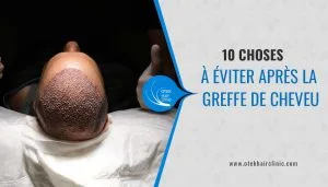 Blog-Fr 73 10 choses a eviter apres la greffe de cheveu