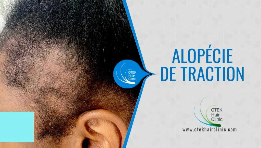 Alopecie de Traction