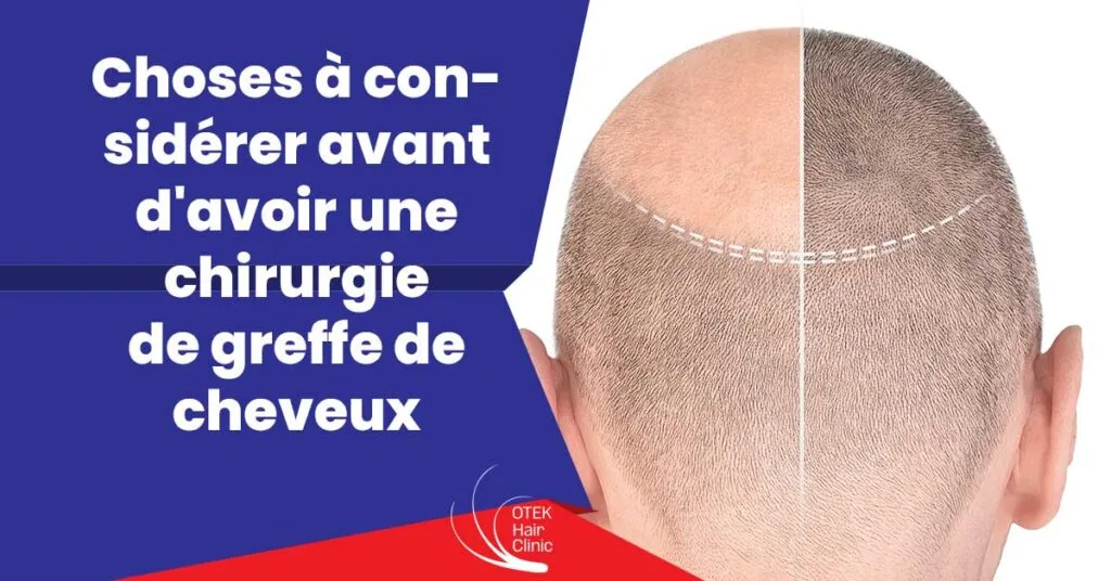 Choses à considérer avant d'avoir une chirurgie de greffe de cheveux