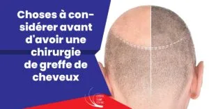 Blog-Fr 69 Choses à considérer avant d'avoir une chirurgie de greffe de cheveux