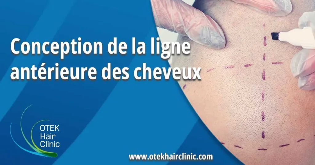 Conception de la ligne anterieure des cheveux