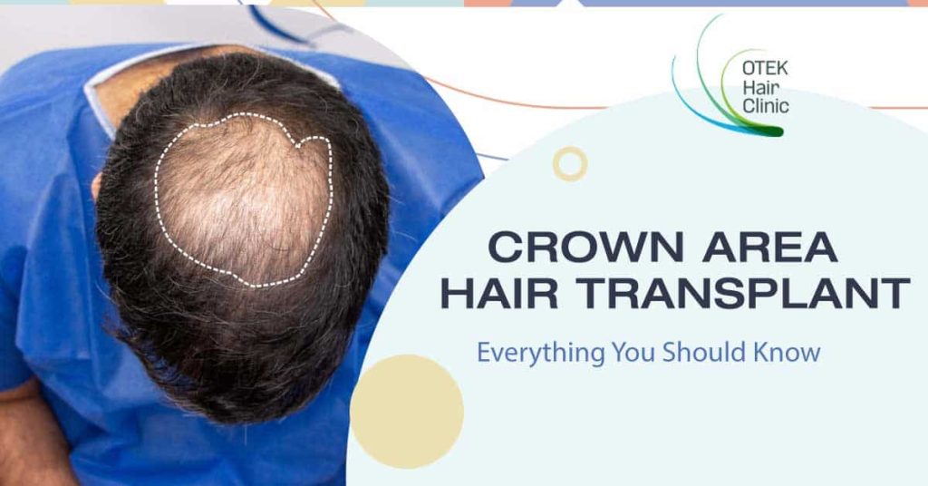 Is It Effective To Have Hair Transplant On Crown Area Of Scalp