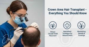 Crown Area Hair Transplant – Everything You Should Know 2