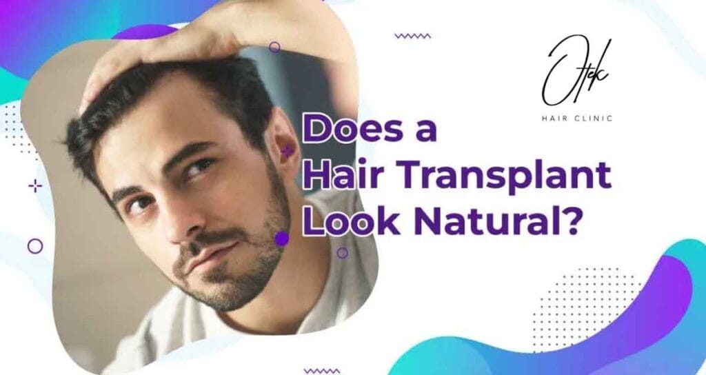 Does a Hair Transplant Look Natural? 2 Does a Hair Transplant Look Natural 1