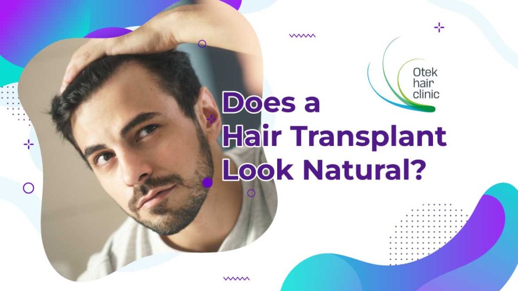 Does a Hair Transplant Look Natural