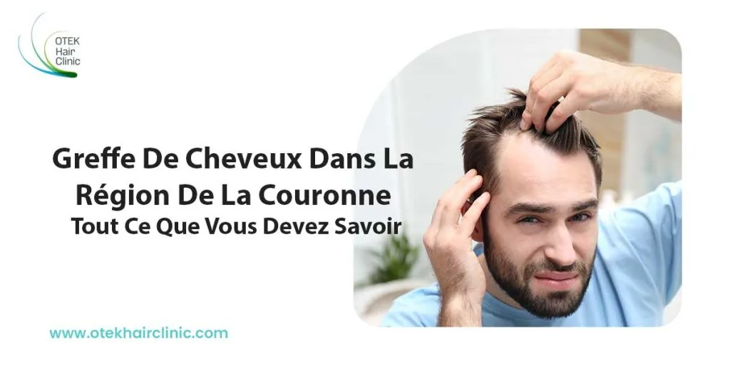 greffe de cheveux dans la Région de la couronne