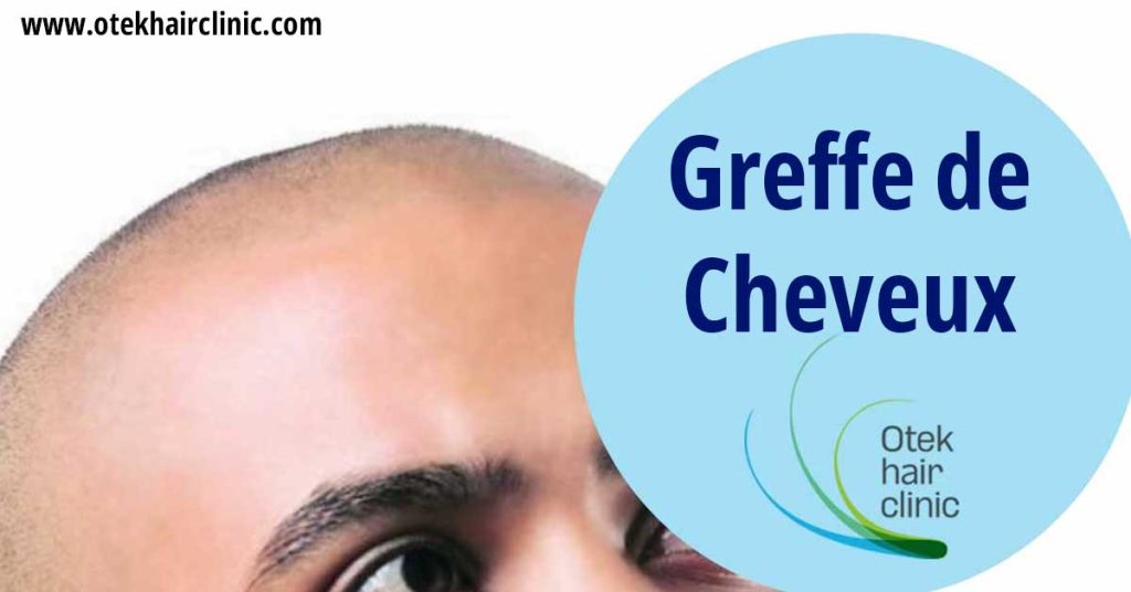 Greffe de Cheveux