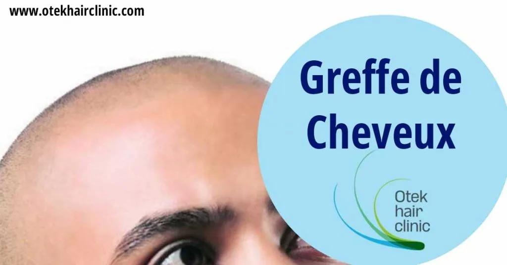 Greffe de Cheveux