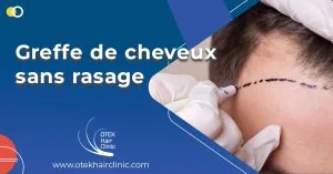 Blog-Fr 70 Greffe de cheveux sans rasage