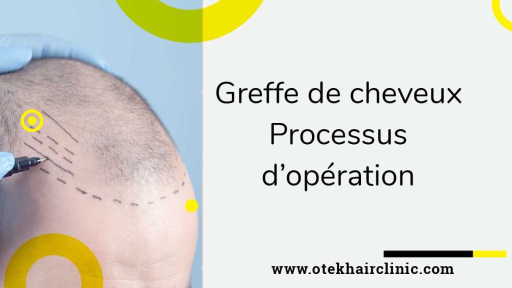 Greffe de cheveux – Processus doperation