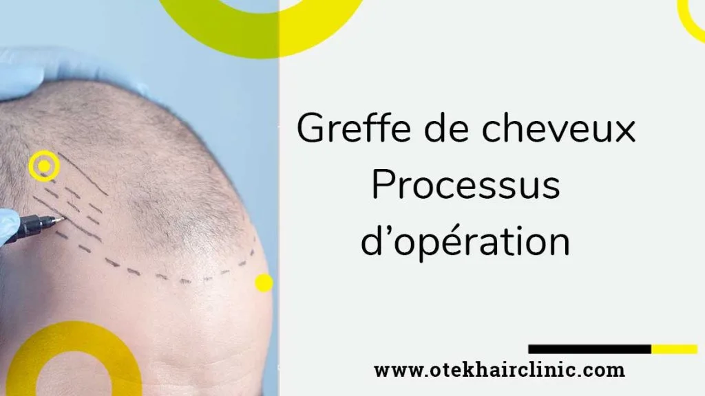 Greffe de Cheveux – Processus d’Opération 2 Greffe de cheveux – Processus doperation