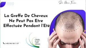 Blog-Fr 76 La Greffe De Cheveux Ne Peut Pas Etre Effectuee Pendant lEte