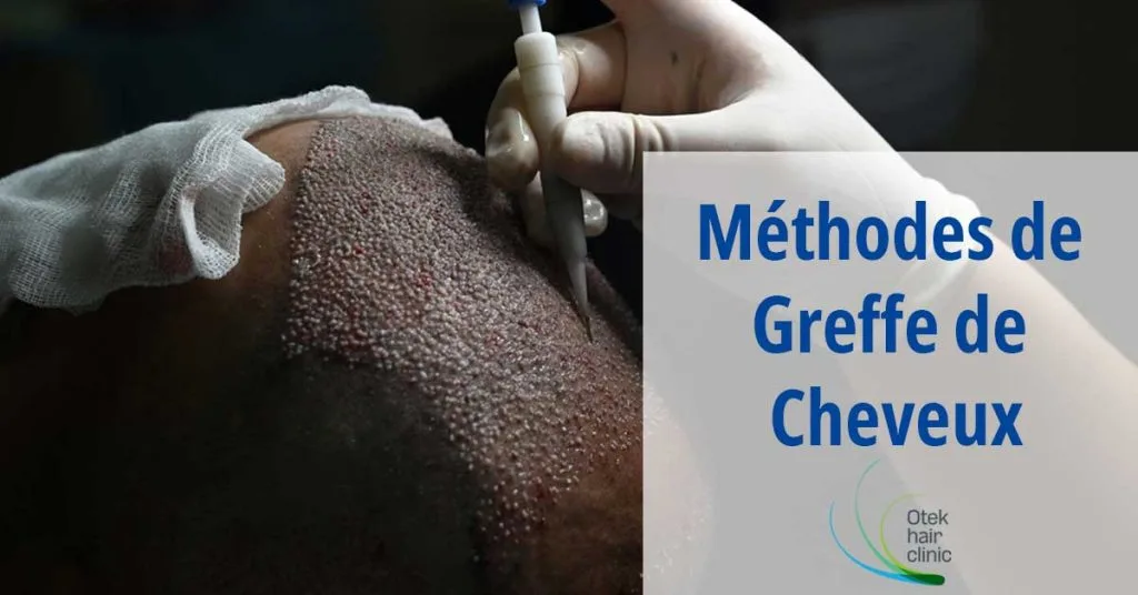 Méthodes de Greffe de Cheveux 2 Methodes de Greffe de Cheveux