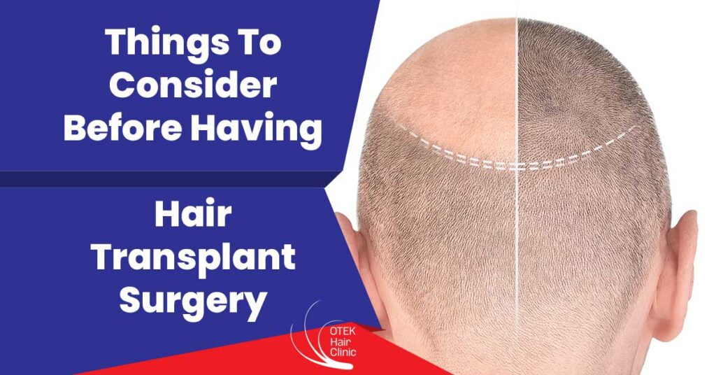 Things To Consider Before Having Hair Transplant Surgery