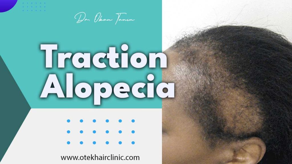 Traction Alopecia otek hair clinic