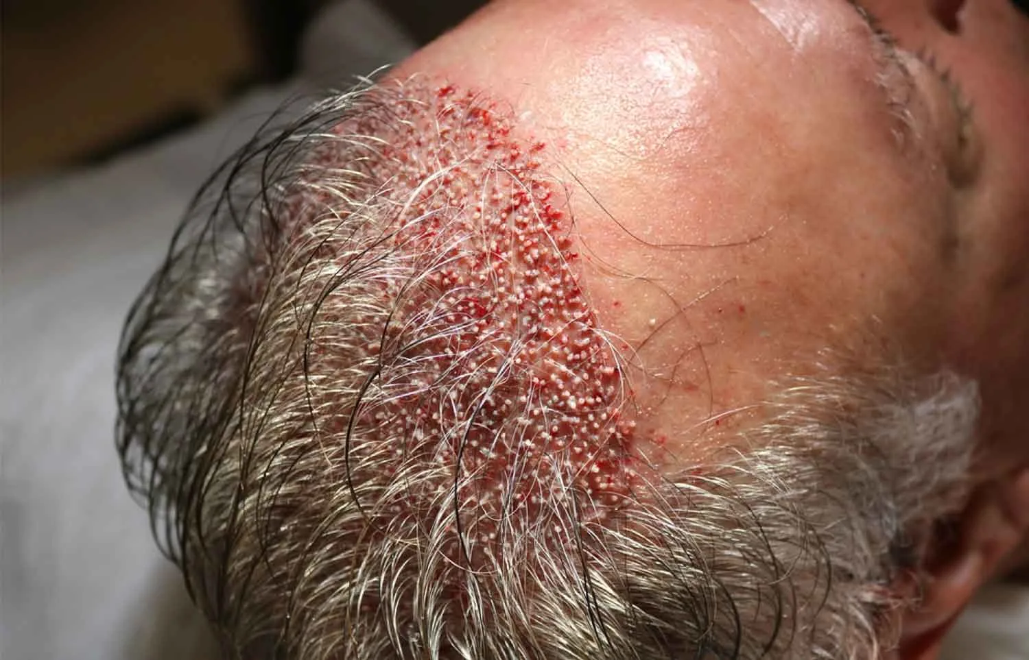 Page D'accueil 10 Unshaven Hair Transplantation