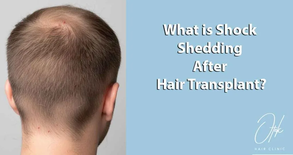 What is Shock Shedding After Hair Transplant