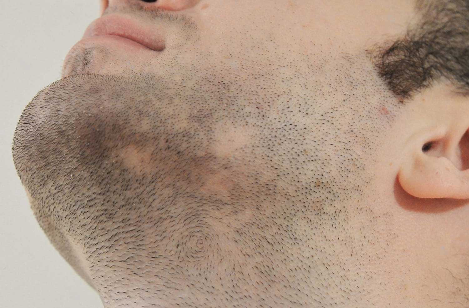 Beard Transplantation - Hair Transplant Antalya/Turkey