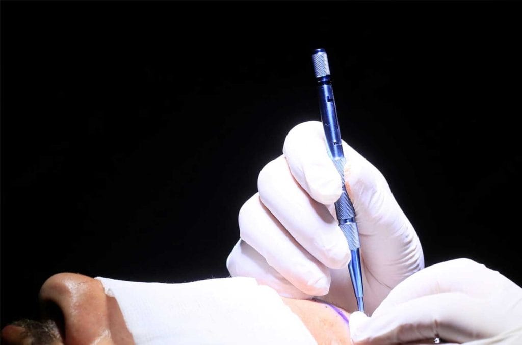 FUE Hair Transplant - Hair Transplant Antalya/Turkey