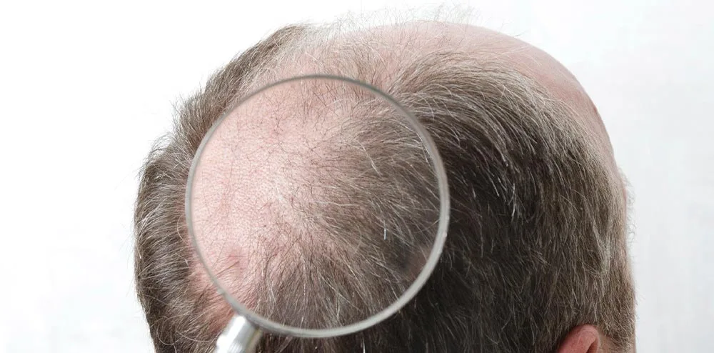 L’importance des Cheveux Dans Différentes Cultures 9 hair loss hormon effect