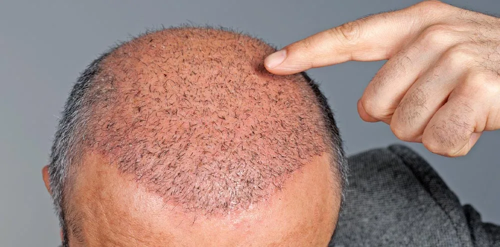 Comment la Zone de Greffe de Cheveux Est-Elle Protégée Des Traumatismes? 2 hair transplant turkey; turkey hair transplant; turkey hair transplant cost; best hair transplant in turkey
