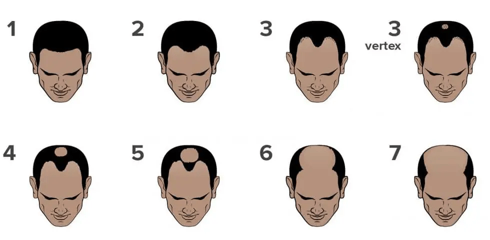 otek hair clinic alopecia types