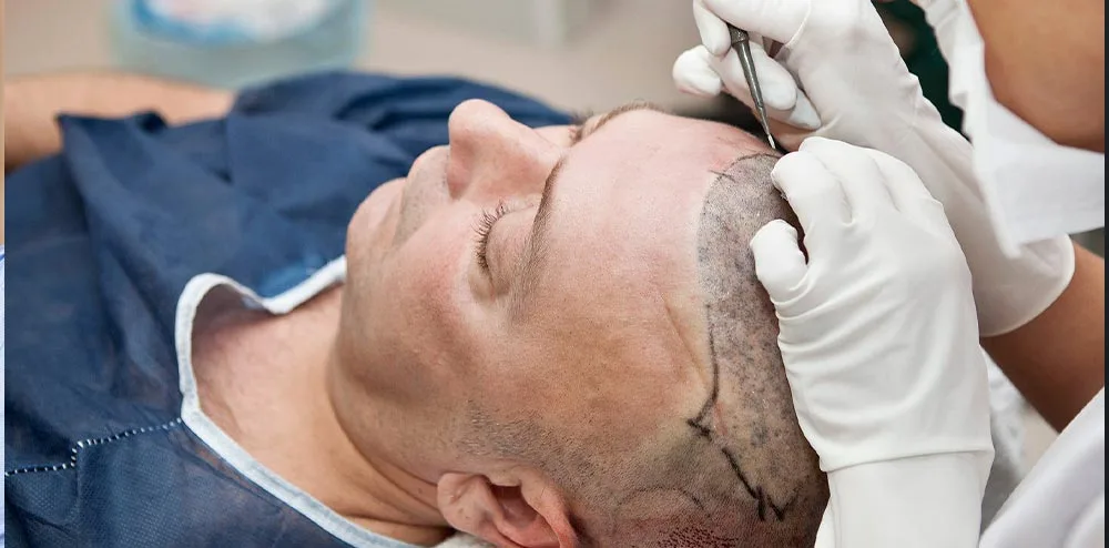 Analyse et Planification de la Greffe de Cheveux 9 otek hair clinic hair analysis