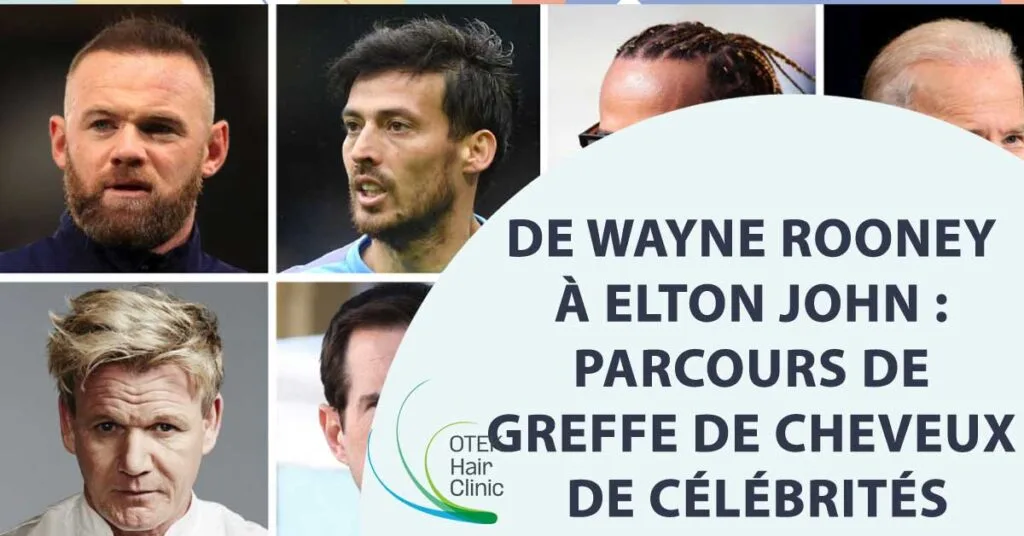 De Wayne Rooney à Elton John : Parcours de greffe de cheveux de célébrités
