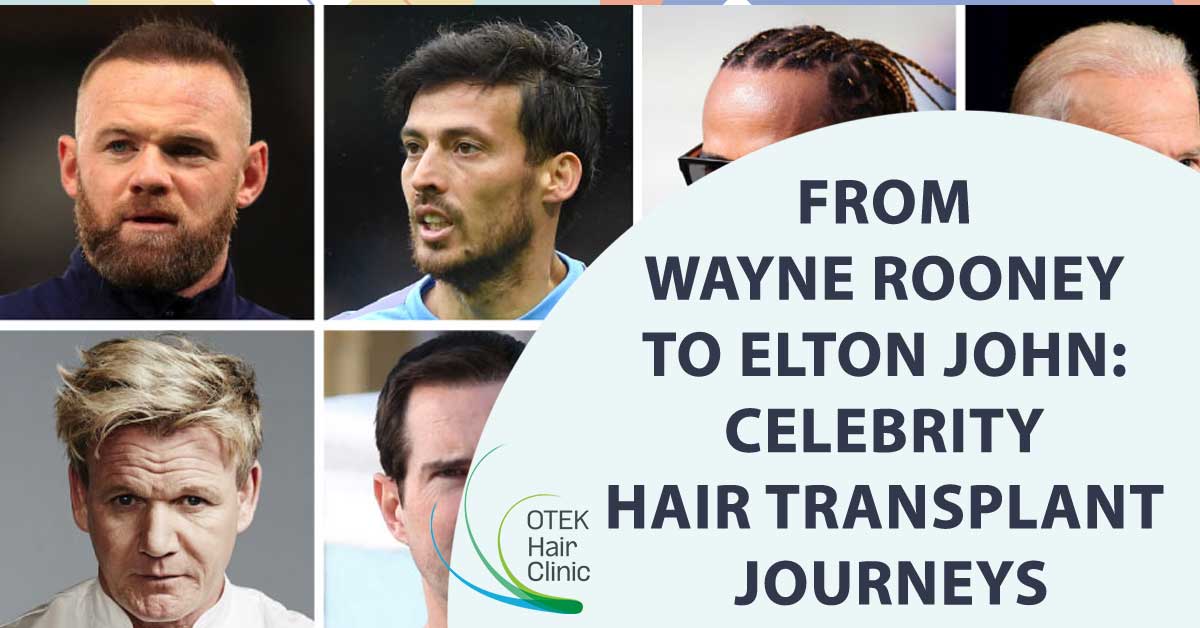 8 Football Players And Their Hair Transplant Stories