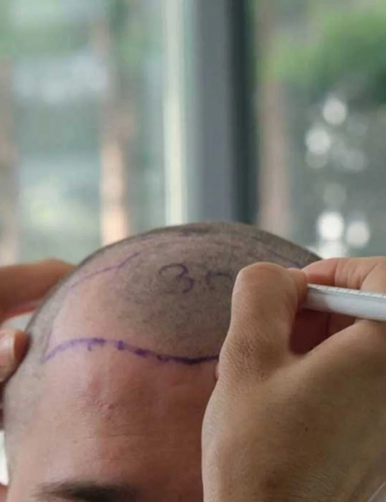 Obtenir un look homogène : l'art de concevoir une ligne de cheveux naturelle et l'importance d'une greffe de cheveux d'apparence naturelle 3 FUE Method Otek Hair Clinic