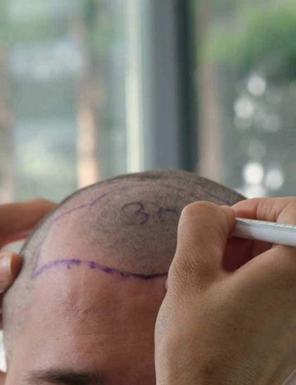 Home - Antalya Hair Transplant 4 FUE Method Otek Hair Clinic