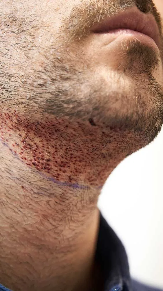 What is a Beard Transplant? 3 beard transplant