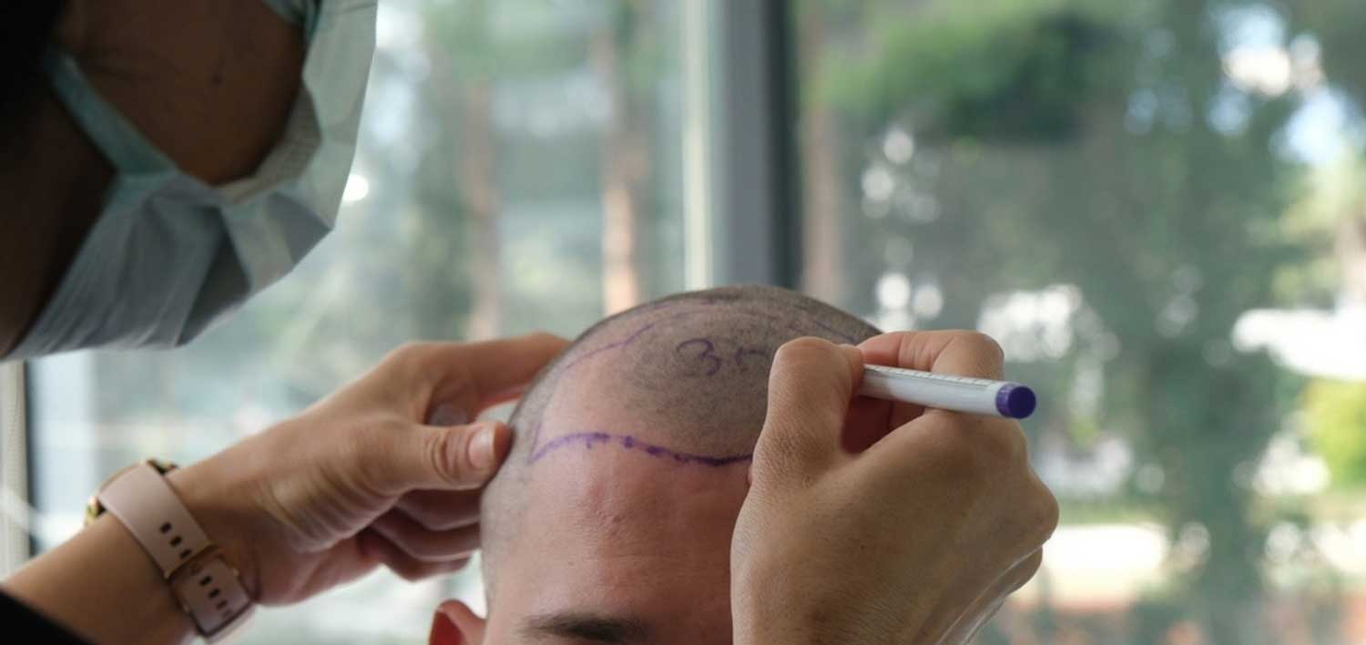 Dhioff DHI Method - Hair Transplant Antalya/Turkey