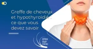 Blog-Fr 61 Greffe de cheveux et hypothyroïdie : ce que vous devez savoir