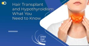 Hair Transplant and Hypothyroidism: What You Need to Know
