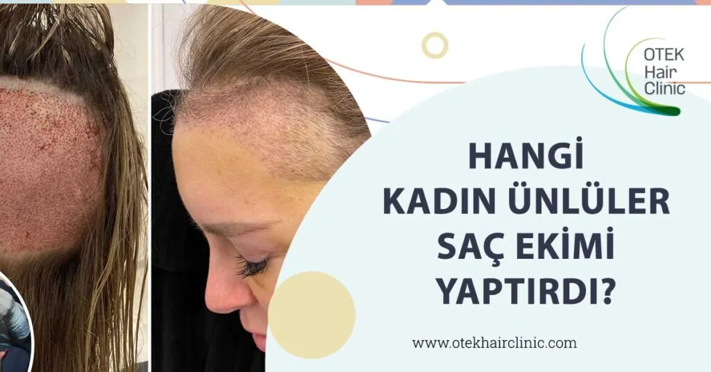 Hangi Kadın Ünlüler Saç Ekimi Yaptırdı?