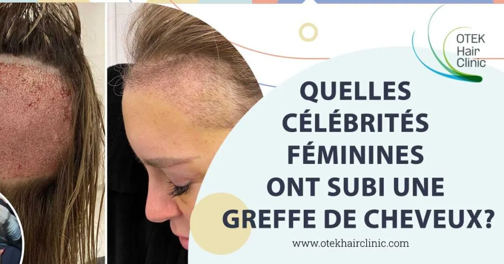 Quelles célébrités féminines ont subi une greffe de cheveux? 2 Quelles célébrités féminines ont subi une greffe de cheveux?