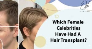 Which Female Celebrities Have Had A Hair Transplant 1