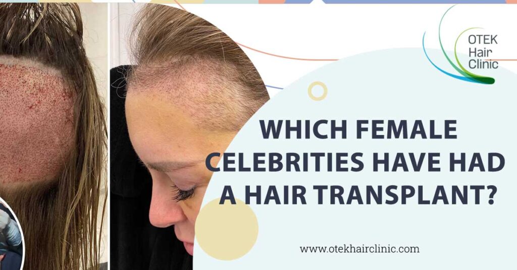 Which Female Celebrities Have Had A Hair Transplant