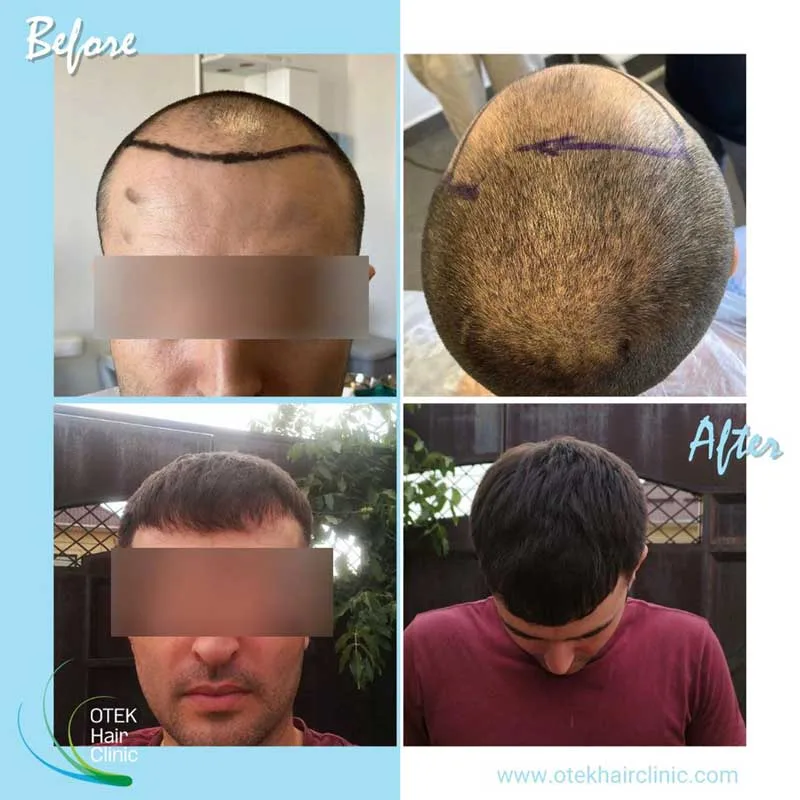 OTEK Hair Clinic 12