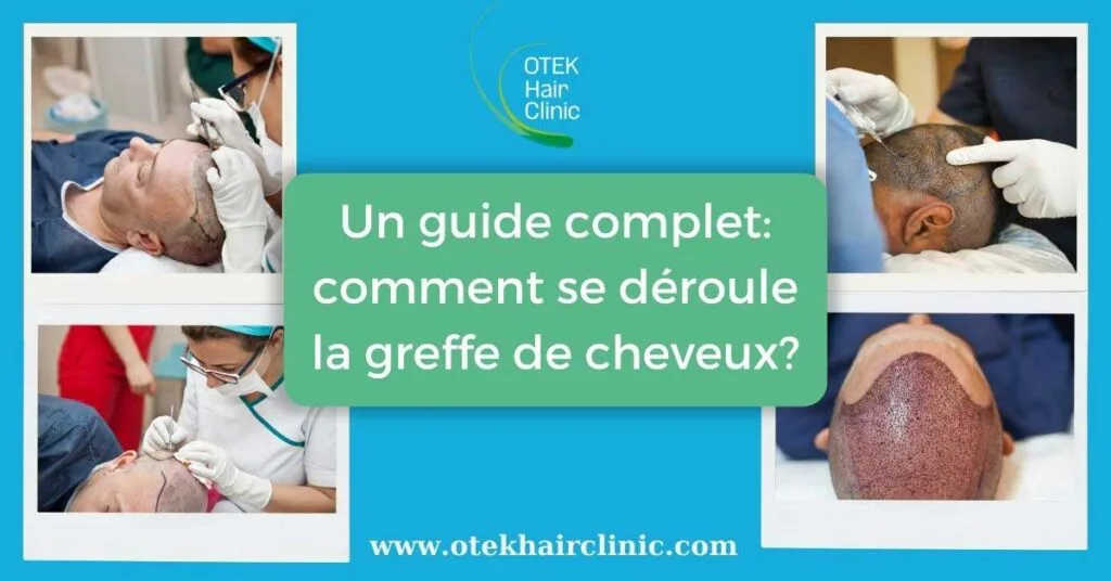 Un guide complet comment se deroule la greffe de cheveux