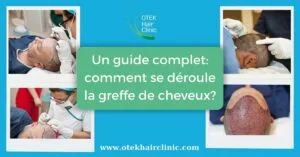 Blog-Fr 49 Un guide complet comment se deroule la greffe de cheveux