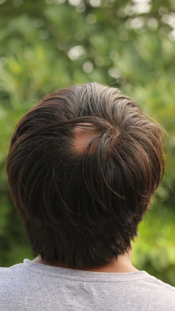 Alopecia Areata: Understanding the Condition and Why Hair Transplants Might Not Provide Relief 5 Alopecia Areata
