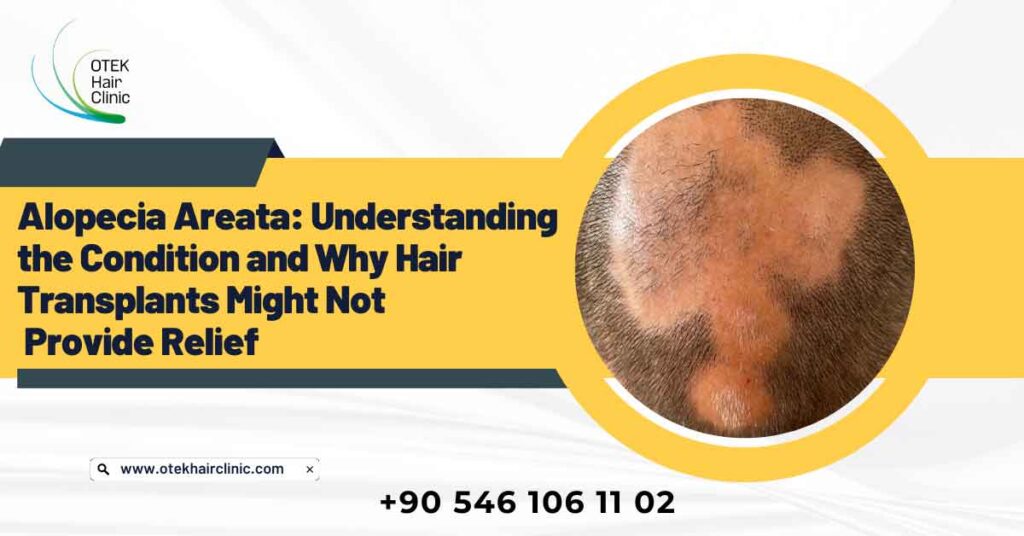 Alopecia Areata Understanding the Condition and Why Hair Transplants Might Not Provide Relief