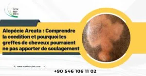 Blog-Fr 46 Alopécie Areata : Comprendre la condition et pourquoi les greffes de cheveux pourraient ne pas apporter de soulagement