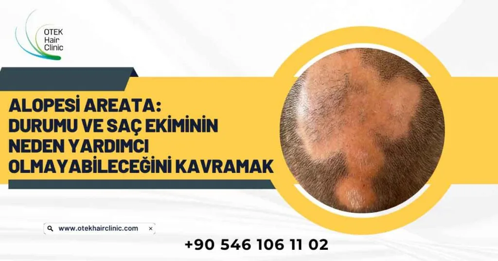Alopesi Areata: Durumu ve Saç Ekiminin Neden Yardımcı Olmayabileceğini Kavramak