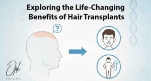 Exploring the Life Changing Benefits of Hair Transplants 1