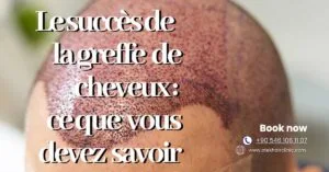 Blog-Fr 48 Le succes de la greffe de cheveux ce que vous devez savoir