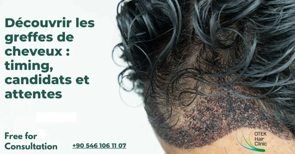 Découvrir les greffes de cheveux : timing, candidats et attentes 17 Decouvrir les greffes de cheveux timing candidats et attentes