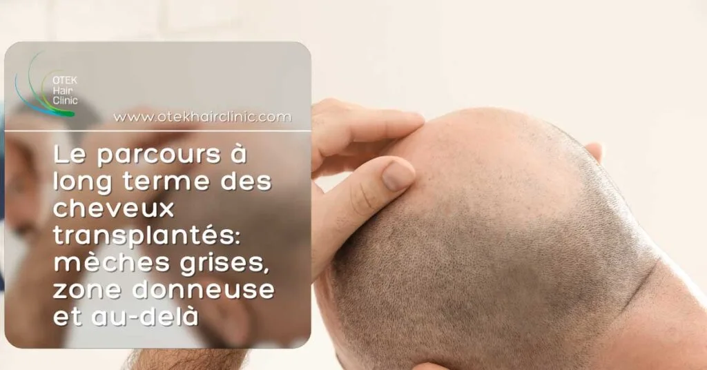 Le parcours a long terme des cheveux transplantes meches grises zone donneuse et au dela